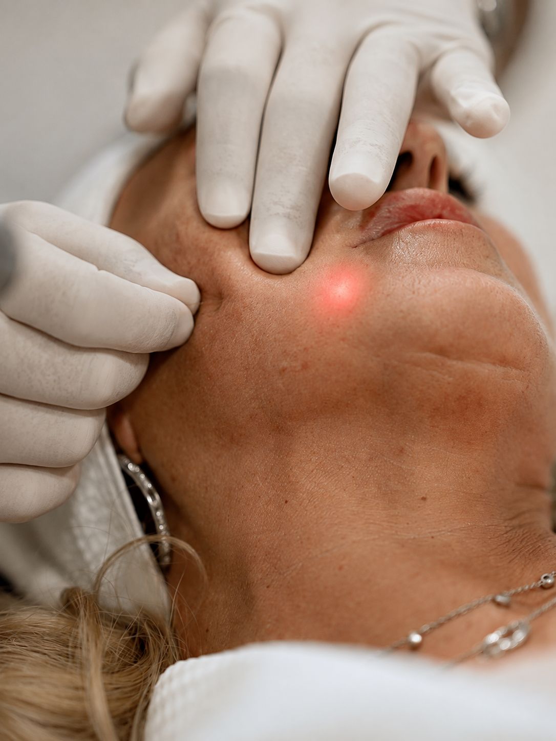 Endolift